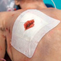 Russell Chest Seal®